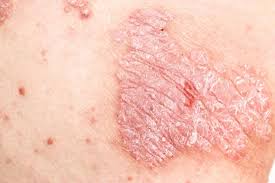Image result for heat rash under breasts