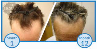 I started using the minoxidil to getting to the root cause of your hairloss would be the first thing to do as if you have an underlying medical condition, once thats treated, it could reverse. Why Am I Losing More Hair After Just Starting Minoxidil