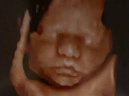 Fundraiser by Jessica Martin : Stand with Layla in Her Fight Against CDH