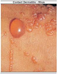 Image result for Rhus Dermatitis