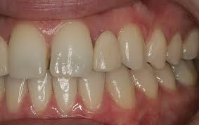 Check spelling or type a new query. Facially Retained Maryland Bridges Volume 14 Issue 10 Inside Dentistry