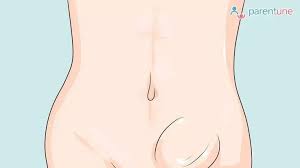 Image result for Inguinal hernia child