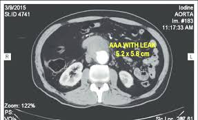 This app works best with javascript enabled. Repeat Ct Abdomen Done After 15 Days Showing An Increase In Size Of The Download Scientific Diagram