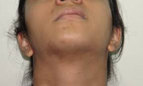 You can greatly reduce the risk of possible side effects by having your treatment performed by a medical doctor who is extremely skilled in using lasers and has. Laser Hair Removal Timeline Hairmd Pune