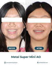 Transformasi senyummu dengan teknologi PT8 Self-Ligating Brackets ✨ 💰  Diskon spesial hingga 4,5 juta 👨‍⚕️ Ditangani oleh Spesialis Orto ______  📲 segera booking konsultasi GRATIS sekarang! 📍Craun Dental Semolowaru  Semolowaru Selatan II /