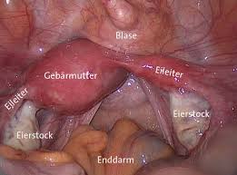 Clarification, management and therapy of associated subfertility. Krankheitsbilder
