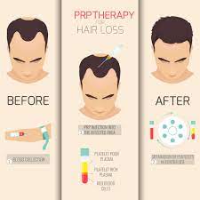 What prp training settings are available? Prp Therapy As Hair Loss Treatment Kl Aesthetic Malaysia