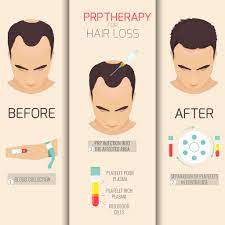 All international students planning to study in malaysia must apply for the visa approval to study in malaysia before entering malaysia. Prp Therapy As Hair Loss Treatment Kl Aesthetic Malaysia