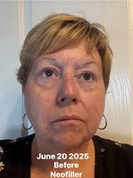 Neofiller reduces smile lines and eye circles