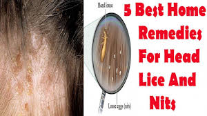 Home Remedies For Head Lice On Furniture Best Color Furniture For You Check More At Http Searchfororangecountyhom Head Lice Remedy Home Remedies Head Louse
