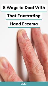 8 Ways To Deal With That Frustrating Hand Eczema Eczema Treatment Eczema Remedies Eczema Relief