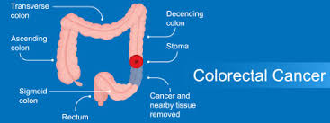 However, if your pain persists after your period, it could be a sign of rectal cancer. Rectal Cancer Causes Symptoms And Treatment Netmeds