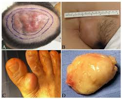 Image result for Dermatofibrosarcoma Protuberans