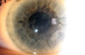 10 Common Questions About Corneas - Ke - Eye Centers Of Texas