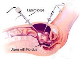 Medical illustration of laparoscopic fibroid removal from the uterus