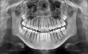 Dental X Rays Https Centralbaldwindental Com Dental X Rays Xray Art Dental Teeth