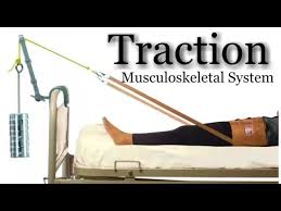 Traction is the application of a pulling force to an injured part of the body or extremity. Traction Orthopedic Hindi Youtube