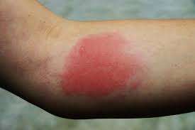 Piqure chenille processionnaire remede grand mere. Piqure De Guepe Allergie Gonflement Que Faire