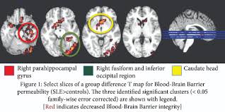 Bbb warning about impostor scams. Evidence Of Altered Blood Brain Barrier Permeability In Systemic Lupus Erythematosus Using Magnetic Resonance Imaging Acr Meeting Abstracts
