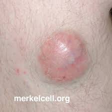 Image result for Merkel Cell Carcinoma