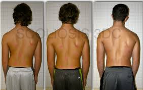 Hard Work Pays Off Improve Scoliosis And Posture With Scoliosis Exercise And Scoliosis Bracing This Patient Scoliosis Yoga For Scoliosis Scoliosis Exercises