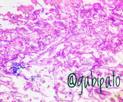 Diseases caused by members of mucorales (genera are rhizopus, rhizomucor, mucor, absidia, aphphysomyces, cunninghamella, saksenaea, etc.) should be named mucormycosis and are. Gaby Pato On Twitter Cute But Deadly Mucor Mucormycosis Pathology Nasal