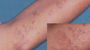 We did not find results for: Lichen Planus Symptoms Diagnosis Treatment And Risks