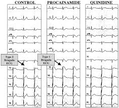 The camel with two humps on its back is the bactrian camel. Brugada Syndrome From Cell To Bedside Sciencedirect