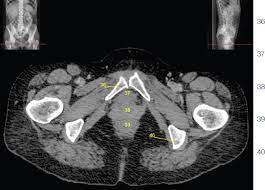 The main focus of this article will be the pelvic floor muscles. Pelvis And Abdomen Radiology Key