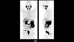 Your doctor needs to learn the stage of the prostate cancer to help you make the best. Detection Of Solitary Pelvic Lymph Node Metastasis In A Patient With Primary Prostate Cancer