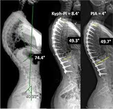 ماذا يحدث إذا لم يتم استخدام حزام تقوس العمود الفقري عند الحاجة؟