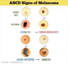 This is why regular skin checks from a professional are so important. Melanoma Causes Symptoms Diagnosis Treatment Prevention