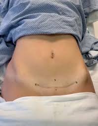 You will have a scar but this will fade over time. C Section Incision Care How To Clean It Properly For Better Healing