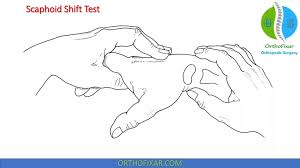 Image result for Scaphoid Shift Test