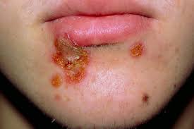 Image result for Impetigo