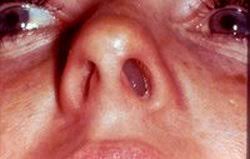 A nasal polyp is a small outgrowth of the mucous membrane tissue that lines the nasal passages and sinus cavities. Nasal Polyps Healthy Inside