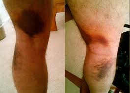 Groin muscle injury or groin pull symptoms. Groin Strain Definition And Synonyms Of Groin Strain In The English Dictionary