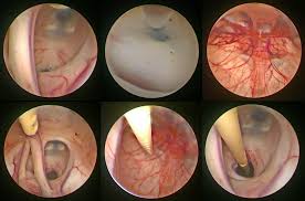 2. Intraoperative Findings. Obstructed Aqueduct Inlet. Transaqueductal...