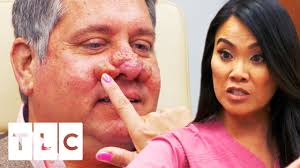 Pimple popper—has more than 2.5 million subscribers; Treating A Severe Case Of Rhinophyma Dr Pimple Popper Youtube