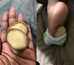 Bila badan berangin rasa loya,kembung perut, sendawa rsa panas d tekak,hujung jari tangan dan kaki rasa sejuk, susah nk brnafas, pening. Petua Untuk Hilangkan Demam Panas Batuk Badan Sejuk