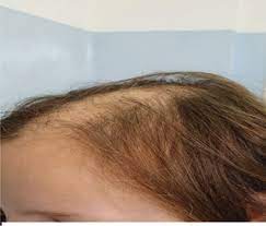 A decrease in hair density and shrinking hair follicles can both cause thinning hair. Hair Loss In Children Etiologies And Treatment Intechopen