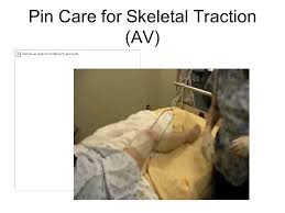 The bracket slips over the beds footboard and is easily transported from bed to bed. Mechanical Immobilization Ppt Video Online Download