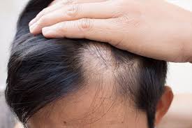 The hair shaft of fine or thinning hair can break easily under high heat, so use your hot tools sparingly if you can. What Commonly Causes Alopecia Areata