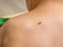 Angiomes plans, stellaires et taches rubis. Laser Angiomes Dr Gandillet Medecine Esthetique
