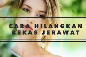 Ada ke cara hilangkan parut hitam di muka? Produk Untuk Hilangkan Bekas Jerawat Berlubang Kesihatan Dan Kecantikan