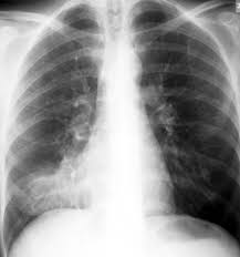 Pneumonia symptoms can vary from mild to severe and depend on the type germ causing the learn about signs and symptoms as well as how pneumonia is diagnosed and if it is contagious. Typical Bacterial Pneumonia Cancer Therapy Advisor