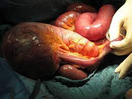 Der ileus ( latinisierte form des griechischen εἰλεός ileós, von altgriechisch εἰλεῖνeilein, deutsch ‚einschließen, zusammendrängen' ), deutsch darmverschluss, ist eine unterbrechung der darmpassage. Doccheck Darmverschluss Hier Seht Ihr Einen Facebook