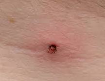 What Do Tick Bites Look Like on Humans? Find Out in Pictures ...