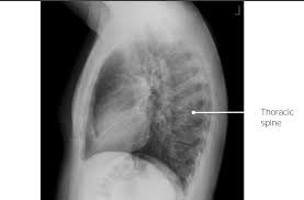 Both lungs should be well expanded and similar in volume. Pulmonary Radiology Concise Medical Knowledge