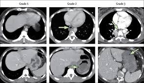 Ingestion may occur where ever loose contamination exists, either in the work place, where it can be picked up on the. Caustic Ingestion The Lancet